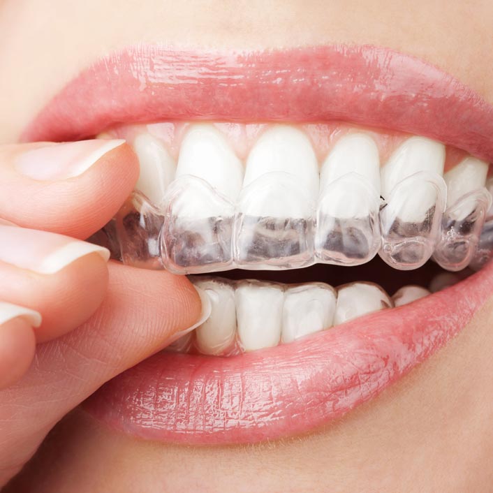 Invisalign - Dental Services