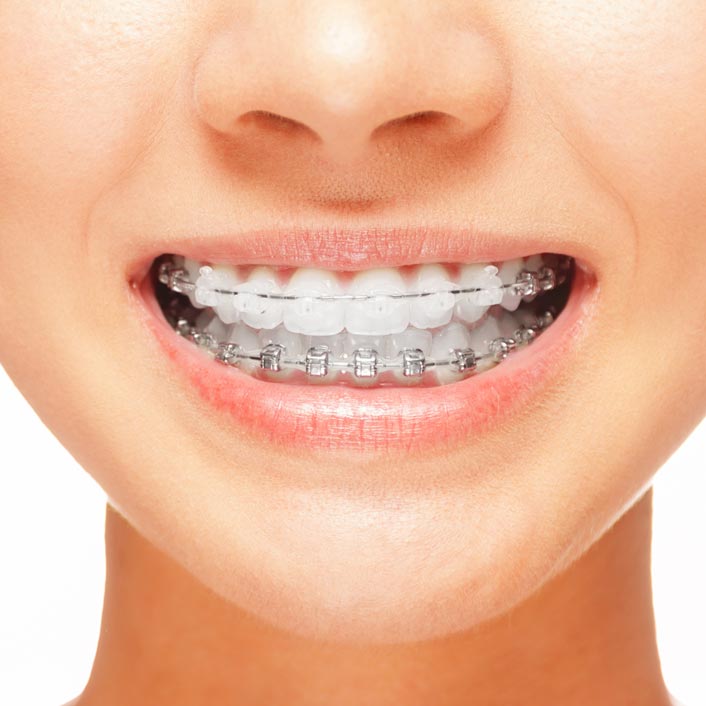 Orthodontics - Dental Services