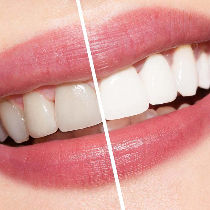 Whitening - Dental Services